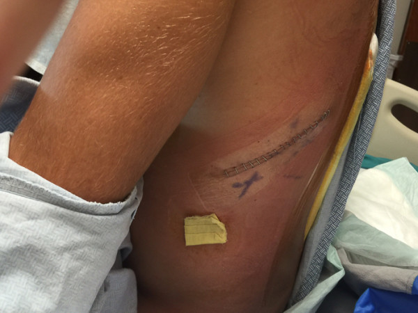 Paul Basagoitia Chest Tube