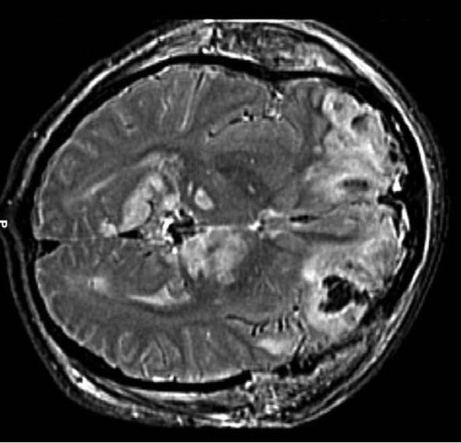 Brain injuries are increasingly more common in all forms of cycling.